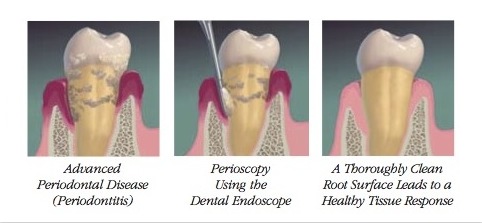 perioscope usage 482x223